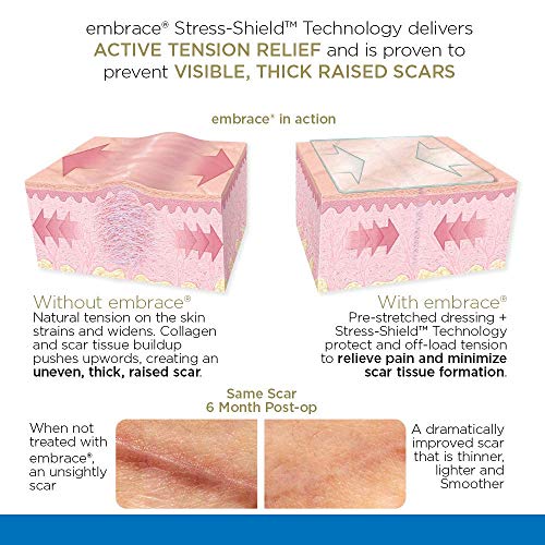 Embrace Scar Treatment, Silicone Sheets for New Scars with Active Scar Defense, Extra Large 6.3 Inch Sheets, 60 Day Supply (Recommended Treatment)