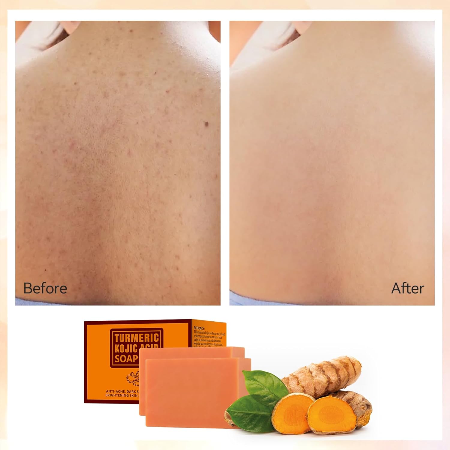 Tamoskiny Koji Acid Soap for hyperpigmentation Turmeric Soap Bar for Dark Spots Tumeric Kojic Acid Soap Dark Spot Remover Skin Soap Hand Soap Acne Face Body Bar Deep Cleansing, 7OZ (2 Bars)