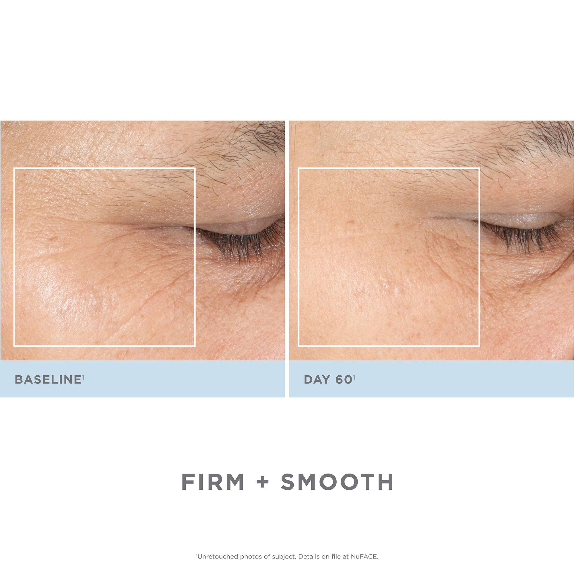 Nuface Trinity Pro Complete Facial Toning Kit