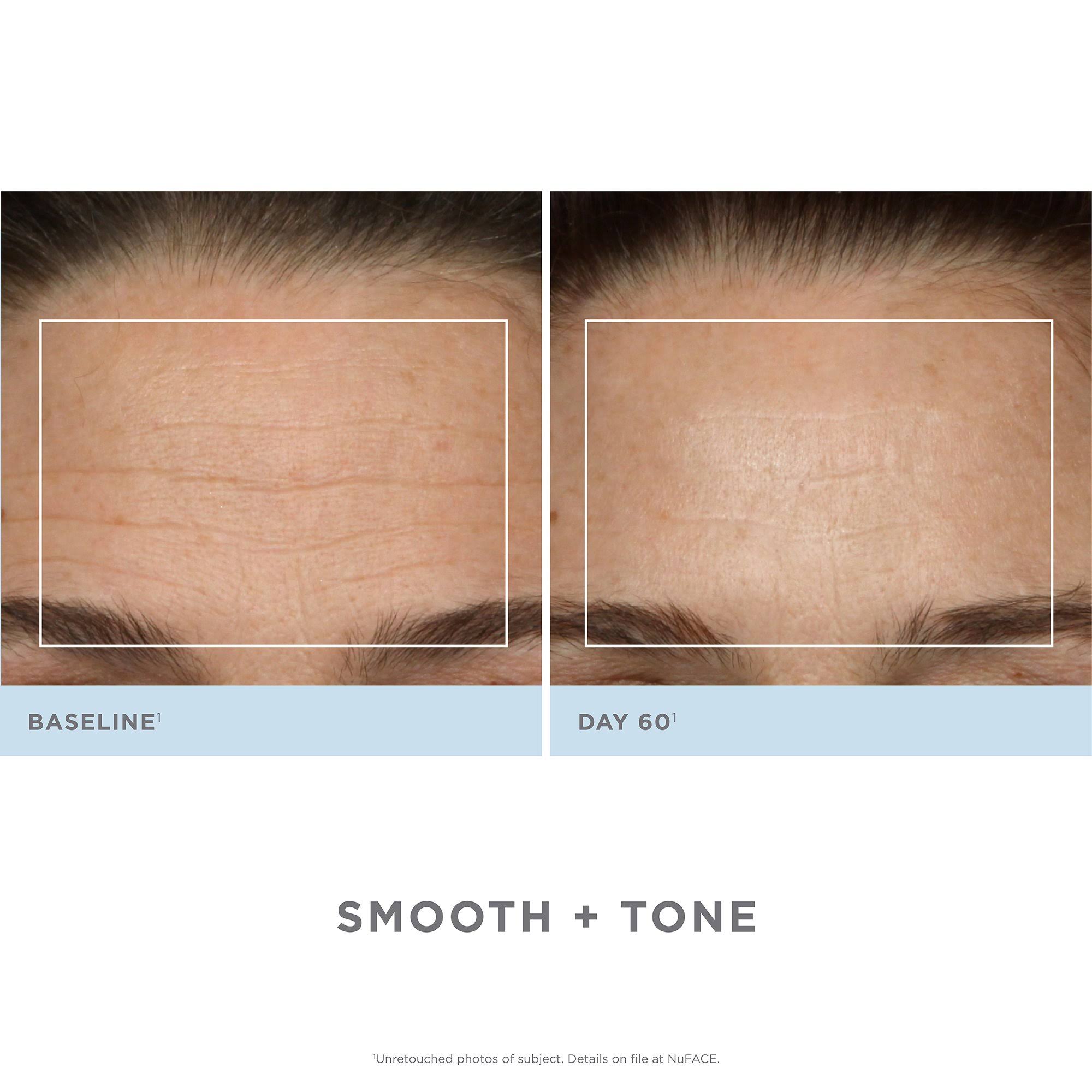 Nuface Trinity Pro Complete Facial Toning Kit