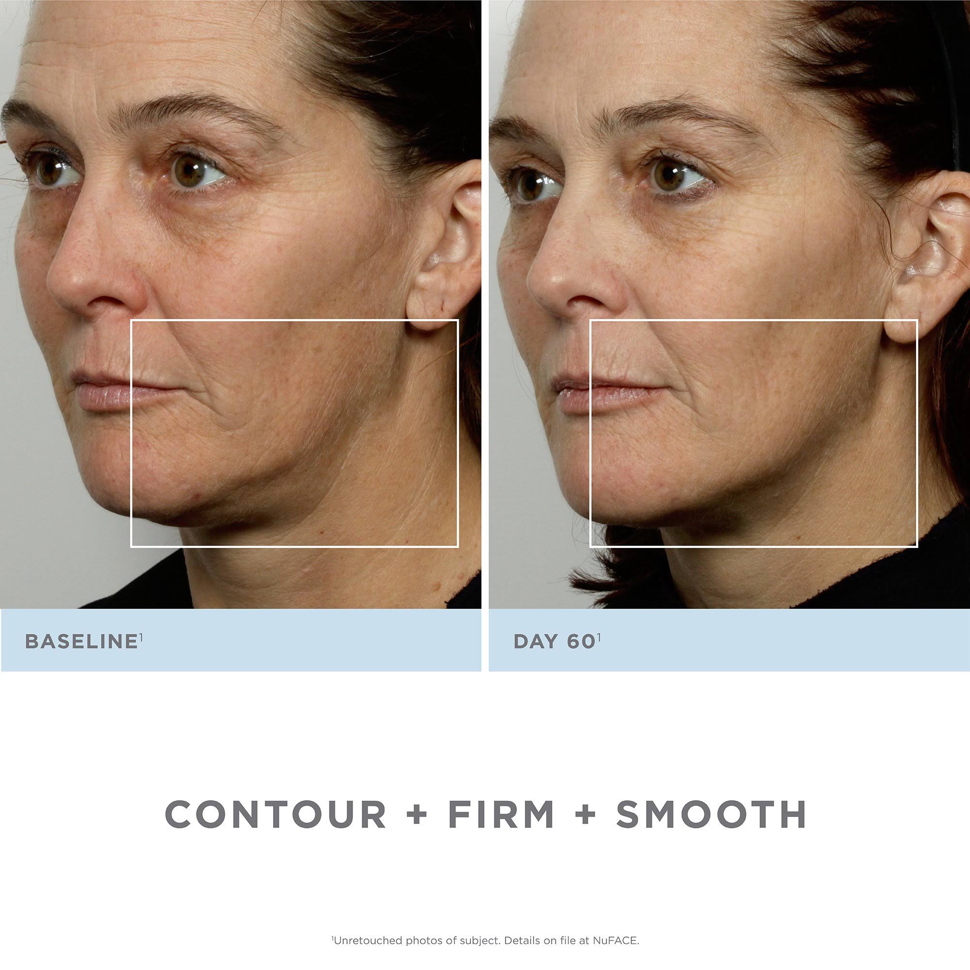 Nuface Trinity Pro Complete Facial Toning Kit